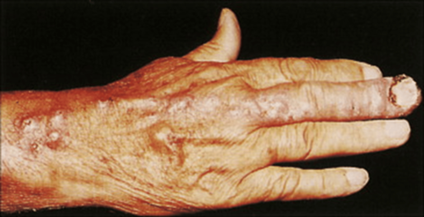 <p>- Rose Gardener's disease</p><p>- Cutaneous and subcutaneous</p><p>- Sporotrichosis (cutaneous, pulmonary)</p><p>- Dissemination only in immunocompromised patients</p>