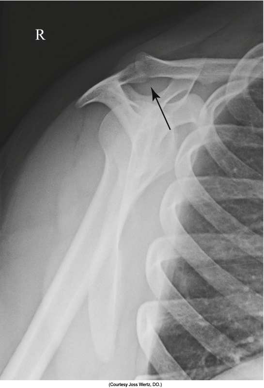 <p>humeral head superior, in centre of IR, flip image so looking front on </p>