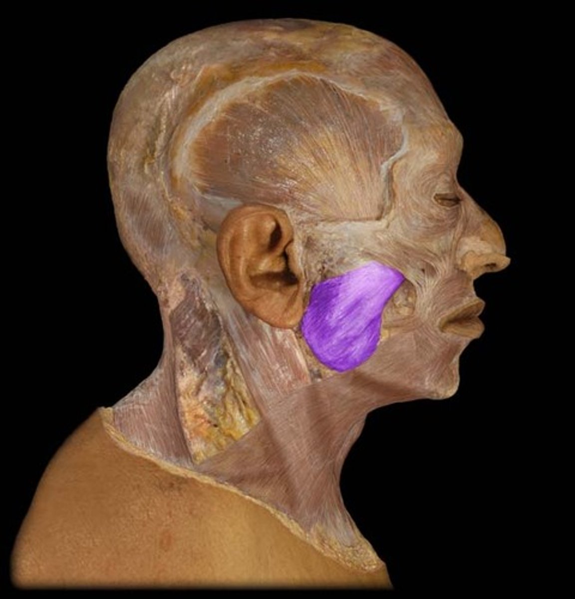 <p>Region:</p><p>Head</p><p>Action: </p><p>Elevates mandible (closes jaw)</p><p>Innervation:</p><p>Trigeminal nerve (CN V3) </p>