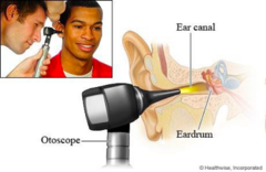<p>TM: intact? Perforation - how big? Thick? Scarring (tympanosclerosis), retraction, cholesteatoma</p><p>Middle ear: effusion - serous vs mucoid?, masses (glomus tumor)</p>