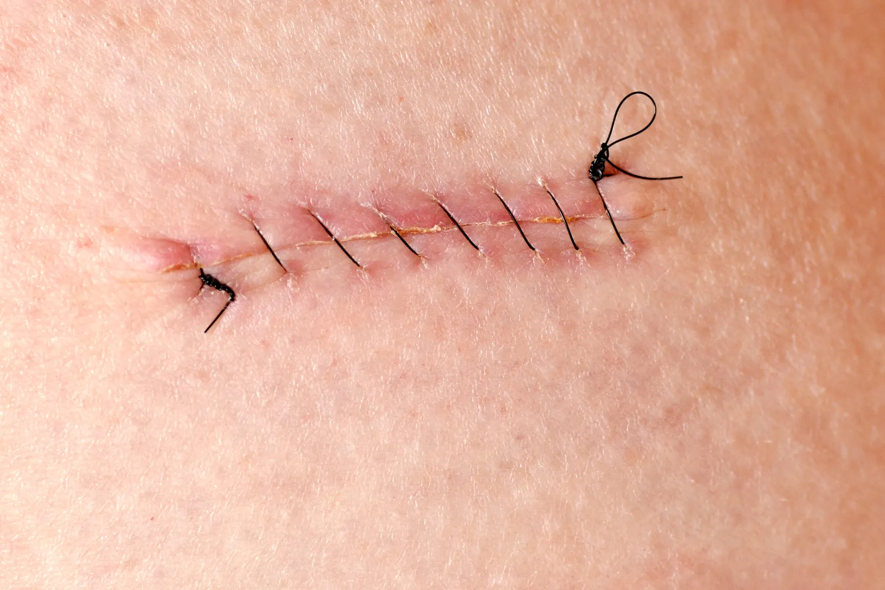 <p>stitches (a stitch)</p>