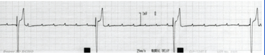 <p>Which degree AV block is this? What is featured on this ECG?</p>
