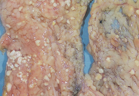 <p>What type of necrosis is this </p>