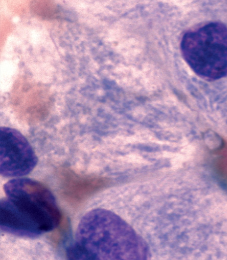 <p>What is the classification, cause, and morphology of Gaucher disease?</p>