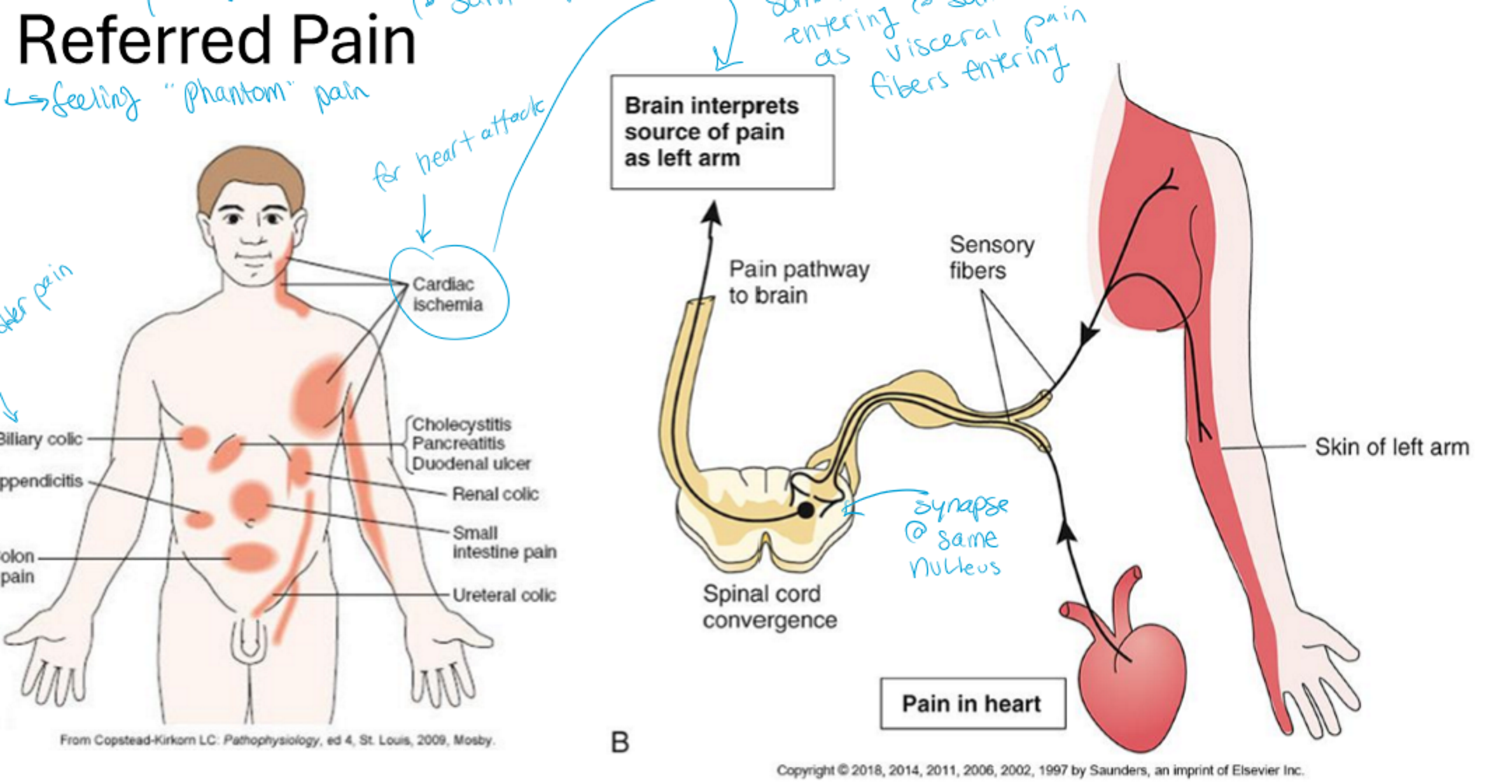 <p>weird innervation patterns where somatic pain enters at same spot as visceral pain</p><p>feeling “phantom” pain</p><p>they meet at the same point so they act the same</p>
