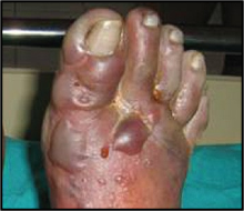 <p>tissue loss involving the entire thickness of skin, hemorrhagic blisters, blue-gray discoloration, "block of wood" then burning throbbing pain</p>