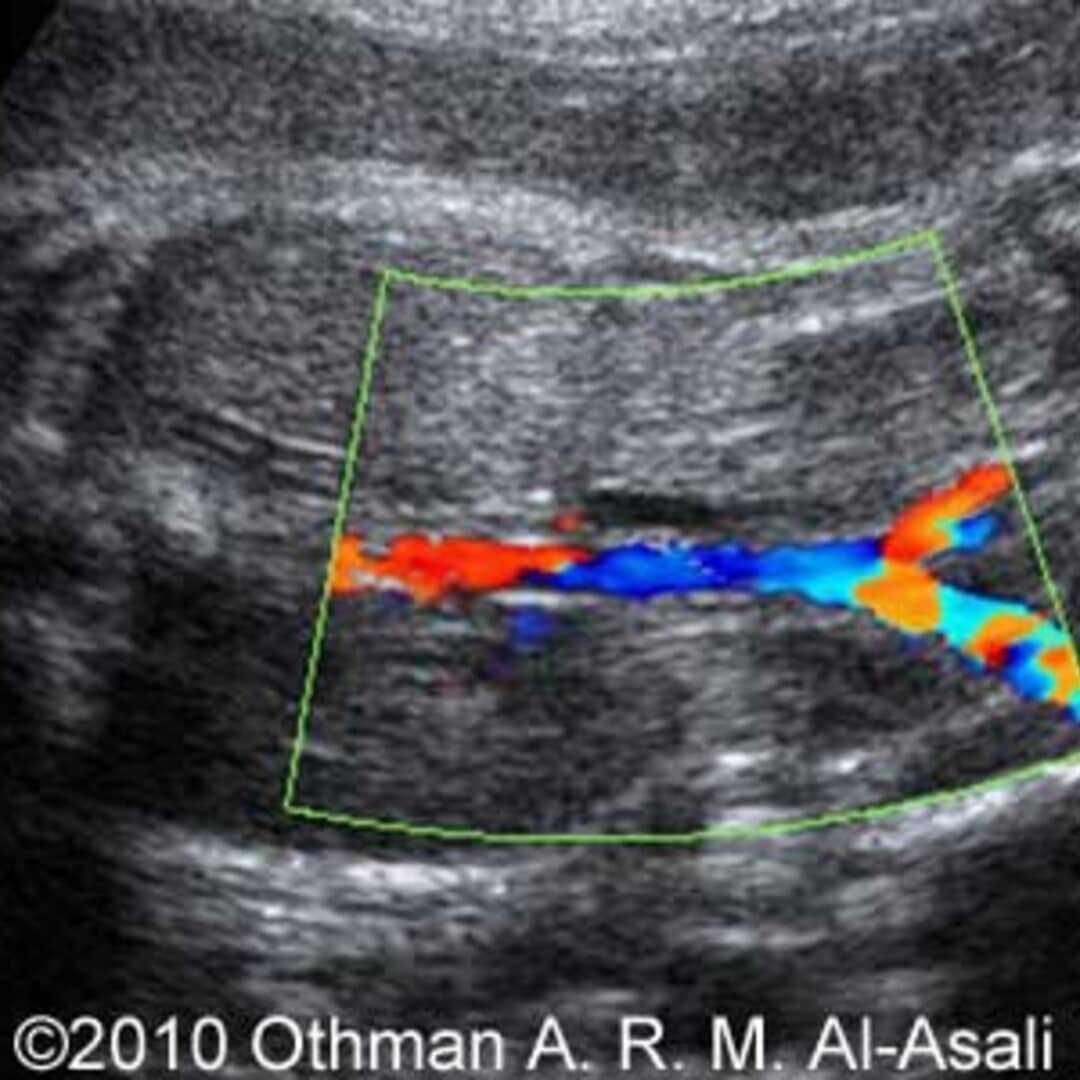 <p>Absent kidneys</p><p>Absent urinary bladder</p><p>Severe oligohydramnios or anhydramnios</p><p>Bilateral lying-down adrenal signs</p><p>Undetectable renal artery branches with color Doppler (bilateral)</p>