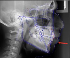 <p>which anatomical landmark:</p><p>- Most anterior point on the curve of the lower lip</p>