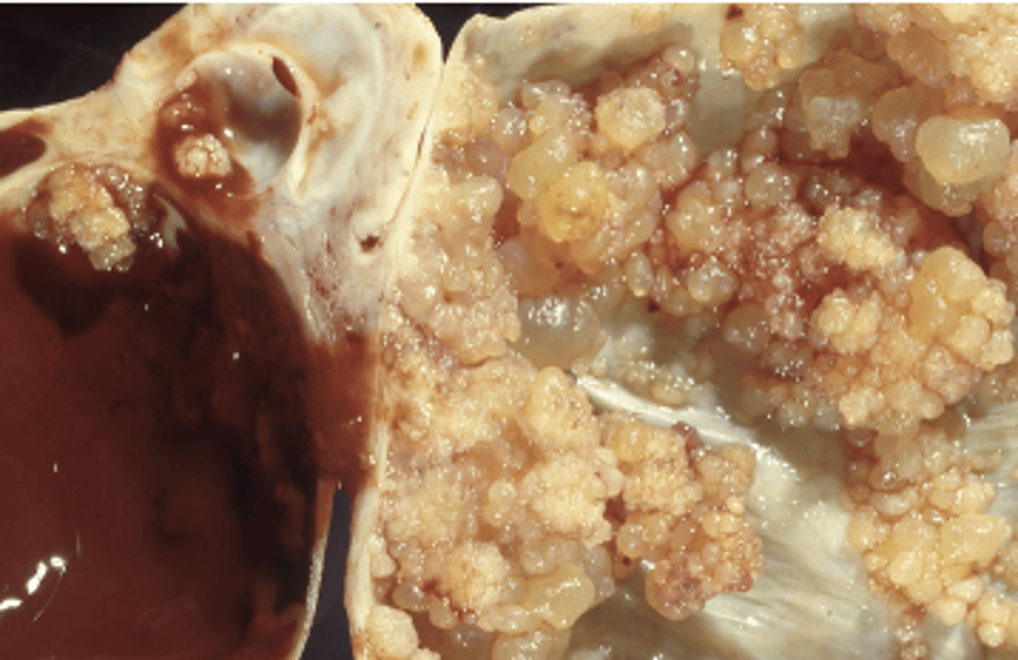 <p>abnormal growths arising in tissue</p>