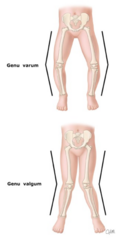 <p>CC: Generally asymptomatic. If older anterior knee pain, worse with running</p><p>History: Rickets, trauma, fractures, neoplasms</p><p>Varum: medial malleoli touching, knees deviate from midline</p><p>Valgum: medial aspect of knee touching, malleoli deviate from midline</p>