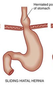 <p>sliding hiatal hernia </p>