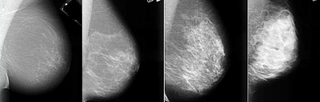 <p>A: Almost entirely fatty</p><p>B: Scattered areas of fibroglandular density </p><p>C: Heterogeneously dense </p><p>E: Extremely dense</p>