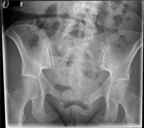 <p>critique sacrum AP axial </p>