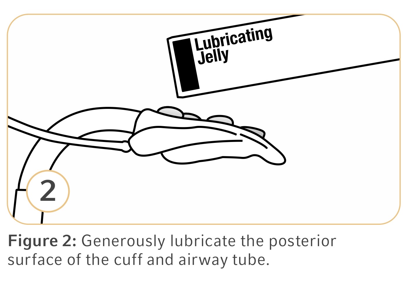 <p>posterior surface of the cuff and airway tube</p>