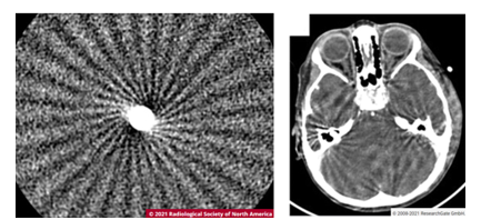 <ul><li><p>« Moulin-à-vent » → seulement sur systèmes hélicoïdaux de <strong>TDM multi-détecteurs</strong>.</p></li><li><p>↑ nombre de rangées → collimation plus large.</p></li><li><p>Faisceau peut devenir <strong>conique</strong> plutôt qu’en éventail.</p></li><li><p>Peut créer artefact de faisceau conique.</p></li><li><p>Similaire au volume partiel lorsque les objets sont en bordure du FOV.</p></li><li><p>Apparence :</p><ul><li><p>stries</p></li><li><p>ombres claires/foncées</p></li><li><p>près des zones avec grandes différences de densité, ex. os/muscles.</p></li></ul></li><li><p>Plus prononcé sur les <strong>rangées extérieures</strong>.</p></li><li><p>Plus le faisceau conique est grand / plus de détecteurs utilisés → effet plus prononcé.</p></li><li><p>Certains protocoles à <strong>64 rangées</strong> n’utilisent donc pas toutes les rangées.</p></li><li><p>Si TDMHR prioritaire et vitesse moins importante → seulement les <strong>32 rangées centrales</strong> peuvent être utilisées.</p></li><li><p>Fabricants → nouveaux algorithmes remplaçant les techniques standard des systèmes à 1 rangée.</p></li></ul><p></p>