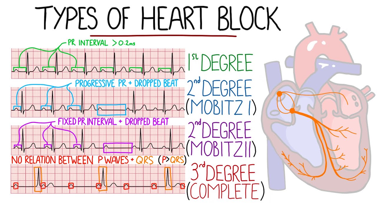 <p>Heart block</p>