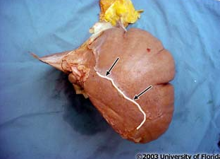 <p>what part of the coronary ligament of the liver is being highlighted?</p>