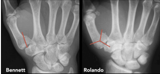 <p>Rolando’s Fracture</p>
