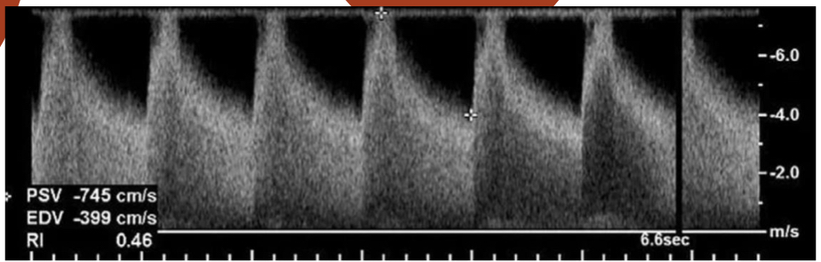 <p>Which doppler finding is most suggested by this waveform?</p>