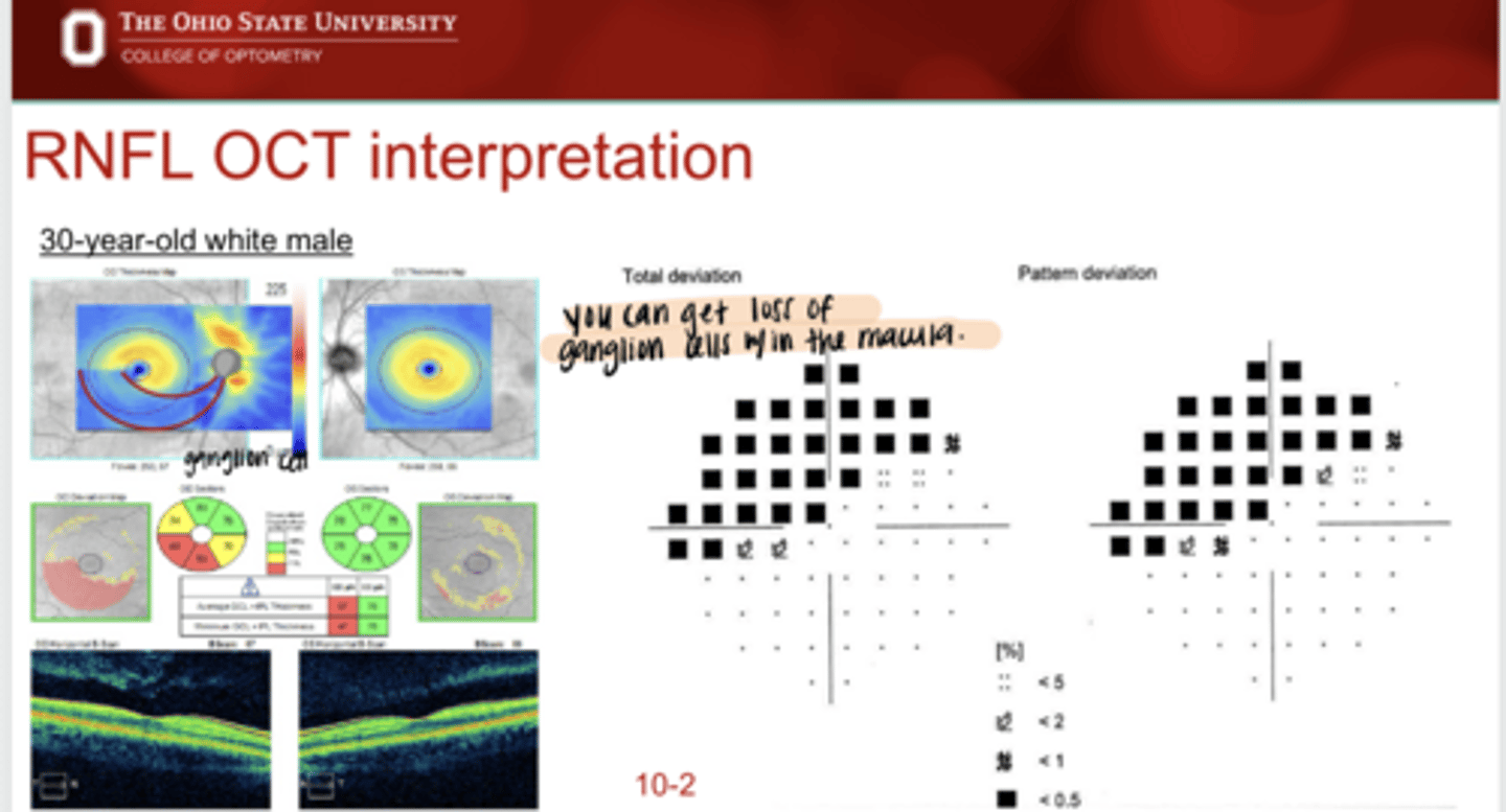<p>Where would you expect a VF defect to be present for an Inferior Temporal Drance Hemmorhage?</p>