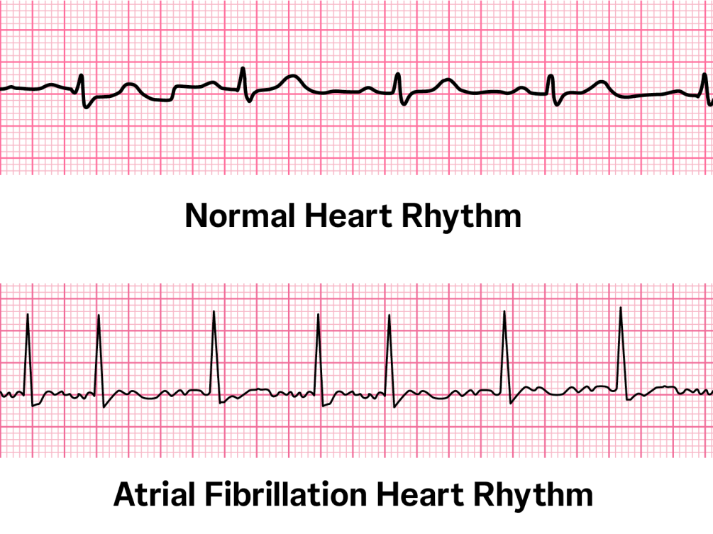 <p>Criteria for ED Cardioversion</p><ul><li><p>new onset AF w/in 48hr</p></li><li><p>CHA2DS2-VASc score less than 1</p></li></ul><p>= anticoag before cardioversion and after x 4 weeks</p><p></p><p>Delayed Cardioversion </p><ul><li><p>AF > 48hr but less than 1 year </p></li></ul><p>= anticoag for 3-4 wk first, then cardiovert, then anticoag 4 weeks after </p><p></p><p><span>Electrical Cardioversion</span></p><p><span>Pharmaceutical Cardioversion → </span>Flecainide. Propafenone, Procainamide, Amiodarone</p>