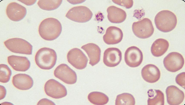 <p>What abnormal RBC shape is shown? What anemia is this MOST associated with?</p>