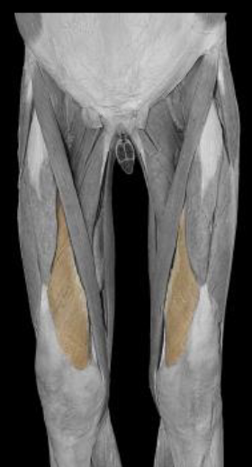 <p>origin of vastus medialis</p>