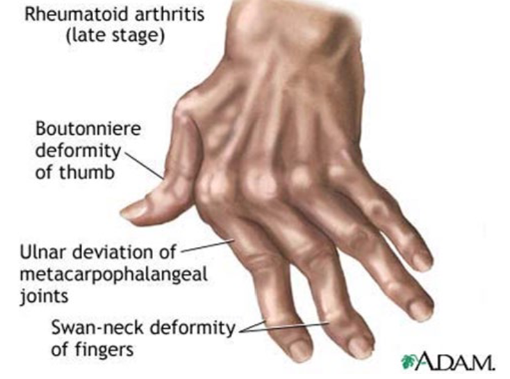 <p>RA is a chronic systemic inflammatory disease of unknown cause. </p><ul><li><p>The autoimmune reaction attacks <span style="color: yellow;"><strong>SYNOVIAL JOINTS </strong></span>around the body.</p></li><li><p><span style="color: yellow;">Abnormal production of numerous</span> cytokines, chemokines, and other inflammatory mediators are seen in<span style="color: yellow;"> RA Paients</span></p></li></ul><p></p><p>Ultimately, inflammation and proliferation of the synovium leads to <span style="color: red;"><strong>destruction of various tissues, including cartilage, bone, tendons, ligaments, and blood vessels.</strong></span></p><p></p>