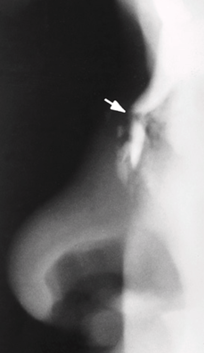 <p>A. Nasal fracture</p>