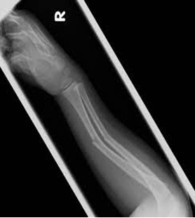 <p>A fracture in a young soft bone in which the bone bends and partially breaks</p>