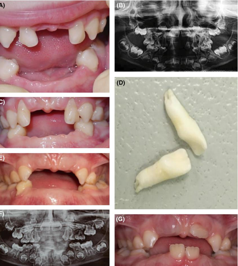 <p>By the time she was 24 months, her front teeth came out—most of her baby teeth have fallen out randomly</p><p>Clinical exam: </p><ul><li><p>Teeth #E, F, O, P missing, no clinical caries</p></li><li><p>Teeth #D &amp; G: Class II mobility </p></li><li><p>Mild localized gingivitis</p></li></ul><p>Radiographic exam</p><ul><li><p>Enlarged pulp chambers</p></li><li><p>Atypical appearance of clinical crown of the permanent molars </p></li><li><p>Thin dentin</p></li><li><p>Horizontal alveolar bone loss</p></li></ul><p></p>