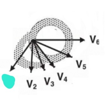 <p>4th intercostal space, right sternum 만나는 지점</p>