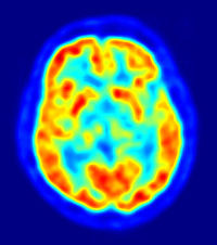 <p>a visual display of brain activity that detects where a radioactive form of glucose goes while the brain performs a given task.</p>