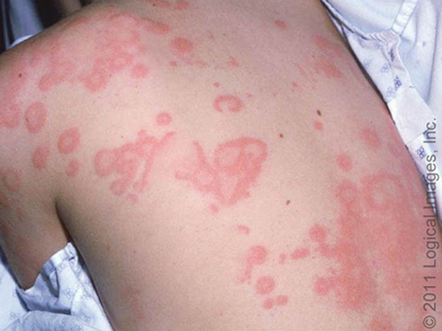 <p>edematous, transitory plaque</p>