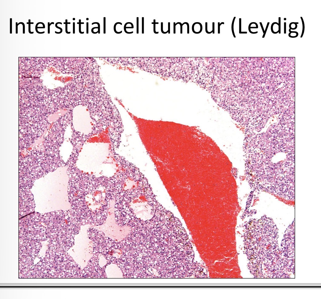 <p>soft, orange, well demarcated, buldging, H, cystic spaces, 1-2cm</p>