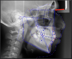 <p>which anatomical landmark:</p><p>- The most anterior point of the intersection between the nasal bone and the frontal bone</p>