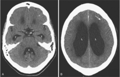 <p>- enlarged ventricles with normal or flattened sulci</p>