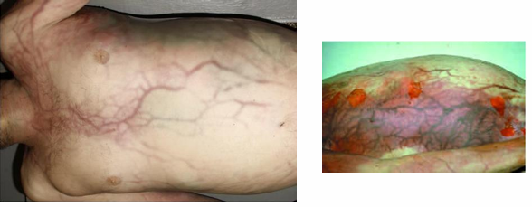 <p>Questions</p><ol><li><p>What postmortem change is characterized by the description provided?</p></li><li><p>What is the cause of the change in the skin?</p></li><li><p>What is the typical timeframe for this change to appear?</p></li></ol><div data-type="horizontalRule"><hr></div><p></p><p></p>
