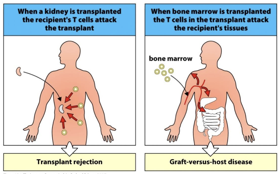 <p> seen in Bone Marrow Transplant</p><p> Mature T cells in marrow attack recipients healthy tissue.</p>