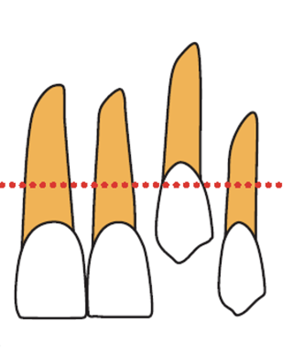 <p>What surgical technique is recommended?</p><p>- Canine cusp is <strong>coronal </strong>to the mucogingival junction (MGJ)</p>