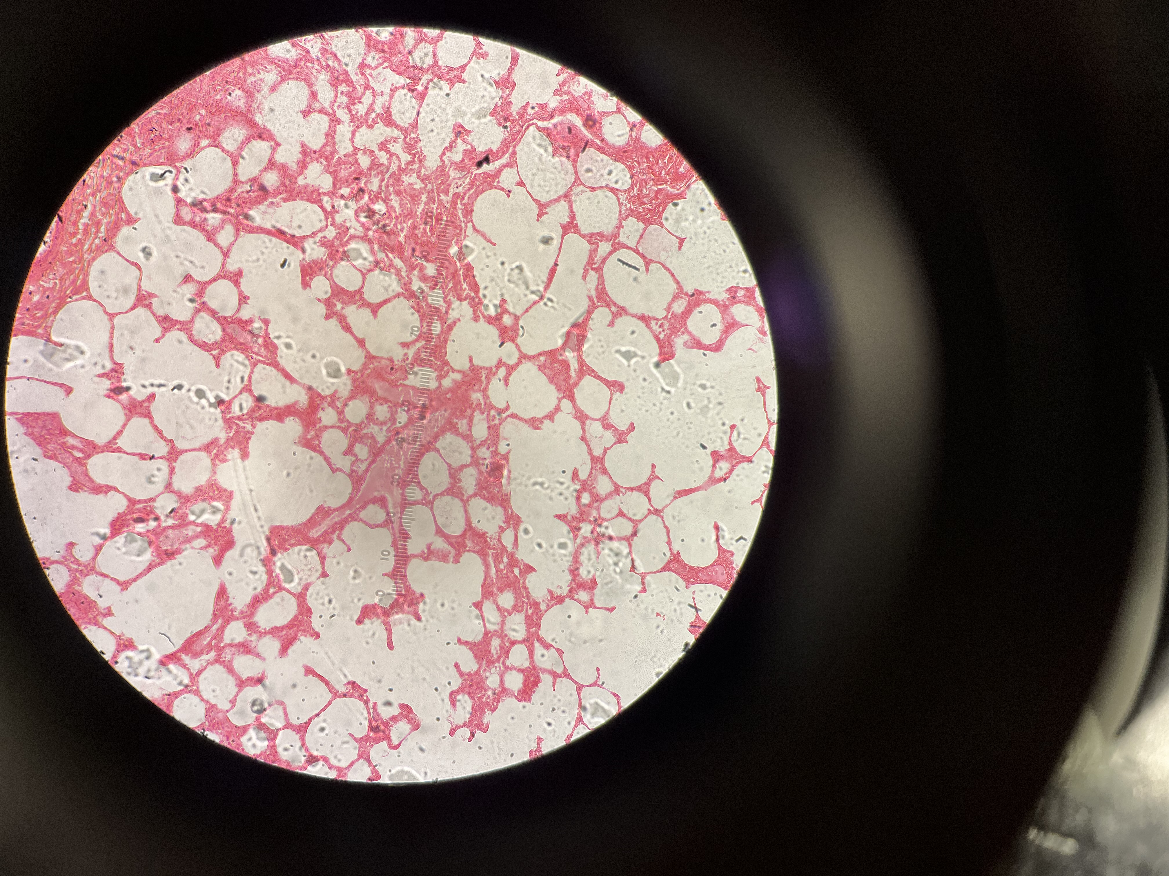 <p>A healthy lung</p><ul><li><p>Features a tight, uniform, and sponge-like array of small, distinct air sacs (alveoli) (2nd image shows alveoli better) </p></li></ul><p></p>
