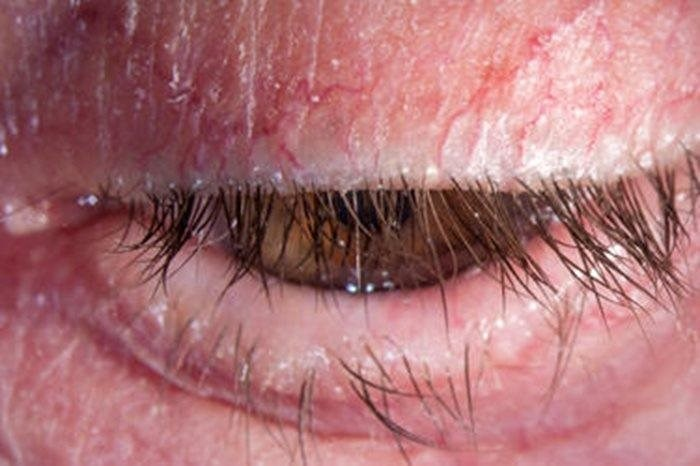 <p><strong><mark data-color="#f7290c" style="background-color: rgb(247, 41, 12); color: inherit;">BLEPHARITIS and MGD</mark></strong></p>