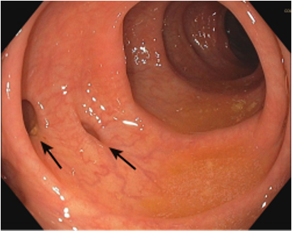 <ul><li><p><span>Colonic diverticula are defects of the bowel wall</span></p></li><li><p><span>They are saclike herniations of the mucosa through the muscularis propria and are actually</span></p></li></ul><p style="text-align: left;"><span> pseudodiverticula because they do not contain the muscle layer)</span></p><ul><li><p><span>Exact pathogenesis of the disease is unknown but is thought to include environmental, genetic, and dietary factors</span></p><ul><li><p><span>Occurs more often with increasing age and as diets including more refined foods (increased refined sugar/white flour, decreased fiber)</span></p></li><li><p><span>Low-fiber diets decrease the amount of intraluminal bulk in the colon. Lack of fecal bulk is thought to produce uncoordinated and irregular colonic peristalsis, which creates sacculations in the colon wall. This results in diverticular outpouchings at weak points.</span></p></li></ul></li></ul><p></p>