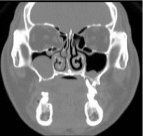 <p>An 18-year-old woman presented with unilateral rhinorrhea for past 2 months. She had a history of road accident 12 months ago. Provide DD</p>