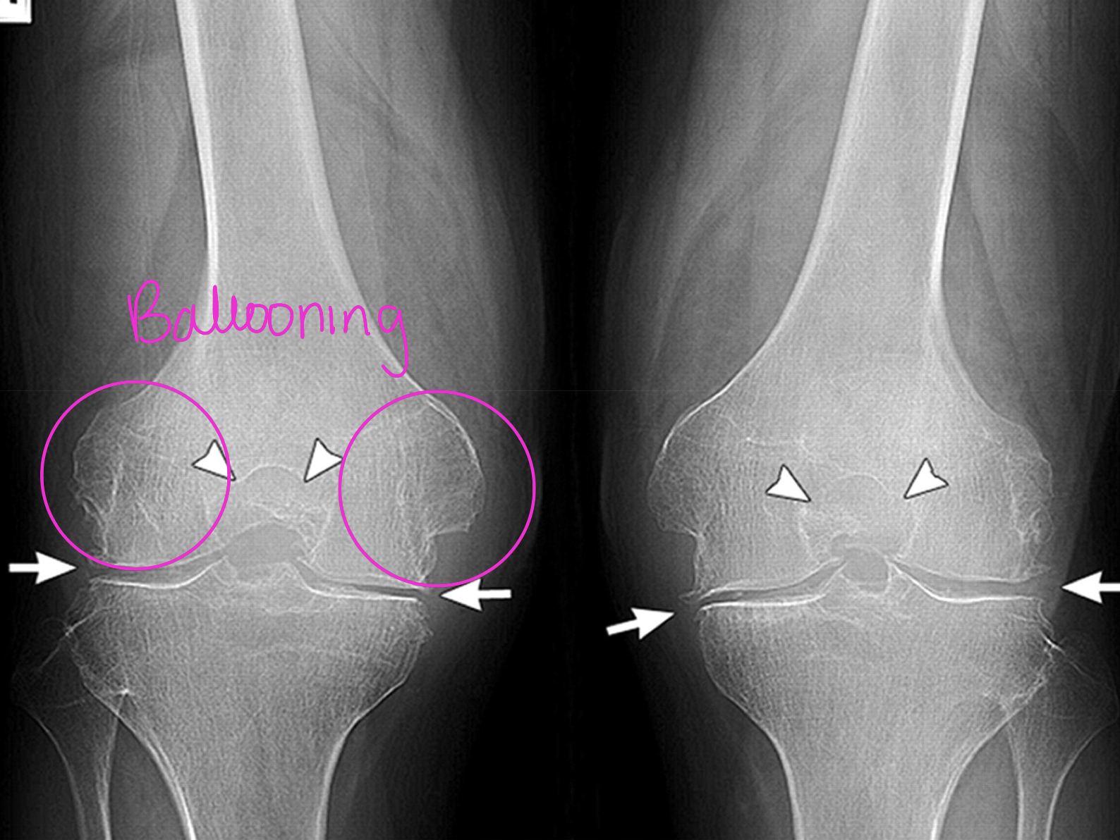 <p>This pt has what two diseases</p>