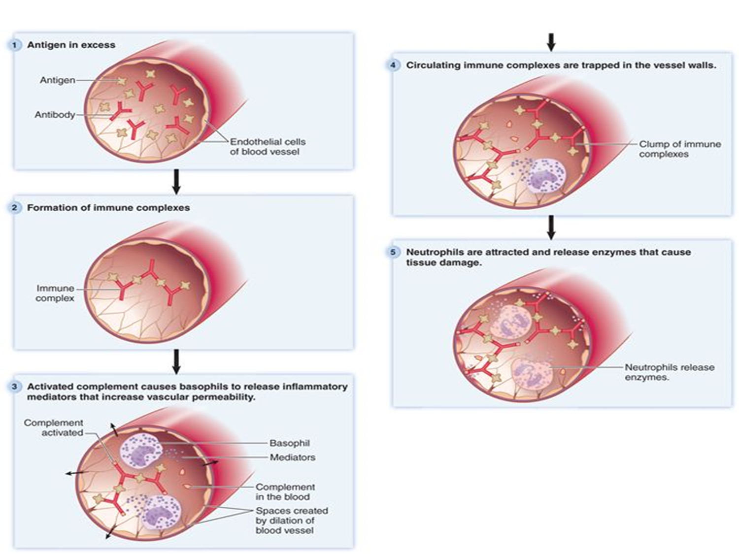 <p>An immune complex is formed when <strong>IgG or IgM antibodies bind to antigens</strong>. Normally, they are cleared by macrophages, but when produced in excess, they <strong>deposit in small blood vessel walls (basement membranes)</strong>, activate complement, and cause inflammation and tissue damage.</p>