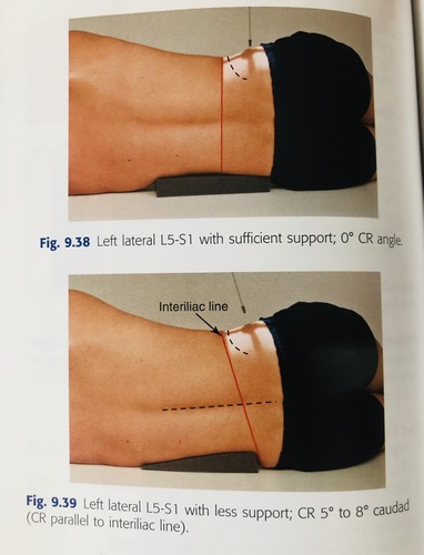 <p>Lumbar spine (L5-S1) projection aimed at imaging the lumbosacral junction in a true lateral position to visualize the intervertebral disc spaces</p>