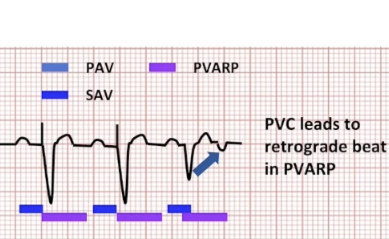 <ul><li><p>Triggering event allows retrograde conduction</p></li><li><p>Retrograde beat lands within PVARP: functional undersensing</p></li></ul><p></p>