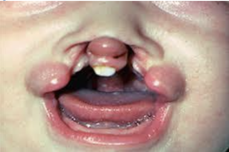 <p>The child shown in the photo can be classified as a bilateral incomplete cleft.</p><p>A. True </p><p>B. False</p>