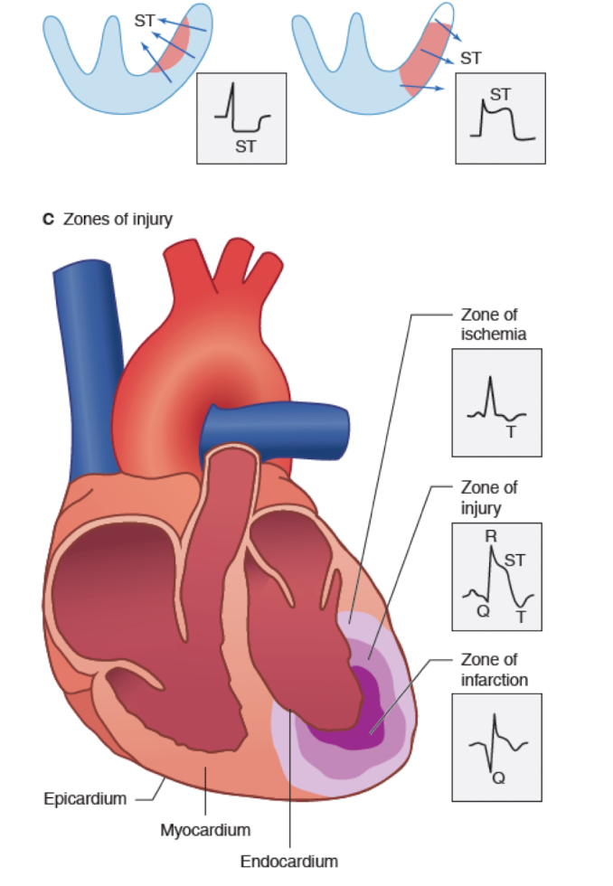<p>necrosis in myocardium due to obstructed blood flow</p><p>Cell and tissue features</p><ul><li><p>reduced contractility of ischemic myocardial fibers</p></li><li><p>Disruption in cardiac conduction system</p></li><li><p>Ischemic cascade</p><ul><li><p>Occlusion initiates steps </p></li><li><p>Electrolyte balance</p></li><li><p>Anaerobic metabolism</p></li><li><p>Systolic and diastolic dyfunction </p></li><li><p>ECG abnormalities (changes depend on many factors)</p></li></ul></li></ul><p></p>